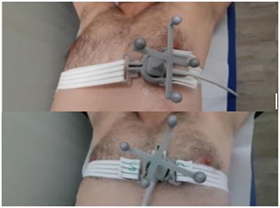 Feasibility of an Automatic Ultrasonographic Image Acquisition System Associated With an Artificial Intelligence Algorithm for Real-Time Monitoring of Cardiac Motion During Cardiac Radio-Ablation